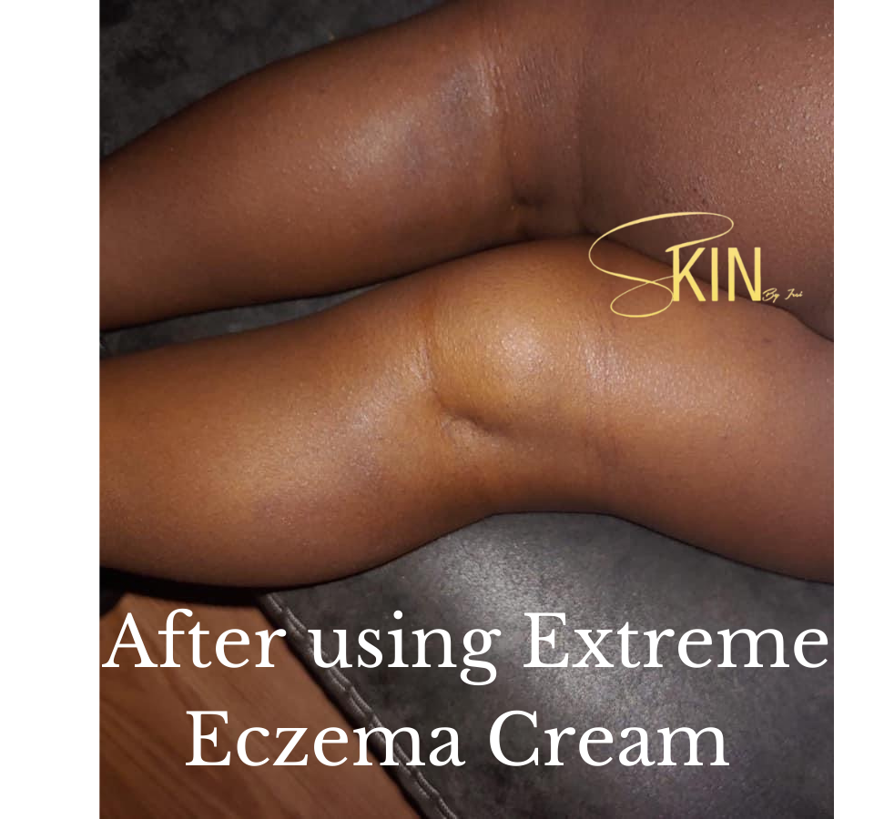 Extreme Eczema Cream