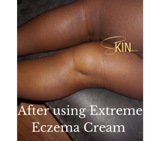 Load image into Gallery viewer, Extreme Eczema Cream
